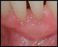 Free Gingival (Gum) Grafts_F Neal Pylant Athens GA_Periodontics_Dental Implants