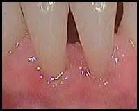 Free Gingival (Gum) Grafts_F Neal Pylant Athens GA_Periodontics_Dental Implants