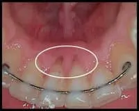 Tongue Piercing_Pre-Flap Surgery_Bone Grafting_F. Neal Pylant, Periodontist