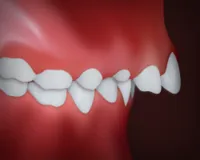 Upper Front Teeth Protrusion