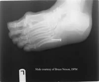 fifth toe fracture