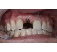 dental implants in new haven ct
