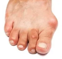 Cleveland Podiatrist | Cleveland Bunions | OH | Robert Portnow, DPM |