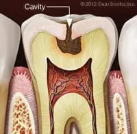 illustration of tooth with cavity, needs restorative dentistry, dental fillings North York, ON