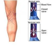  Varicose Veins and Swollen Ankle Care