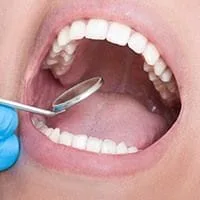 close up of dental mirror in woman's open mouth, metal-free dental restorations in teeth, dentist Melrose, MA