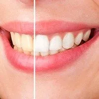 Teeth Whitening from Pan Dental Care in Melrose, MA