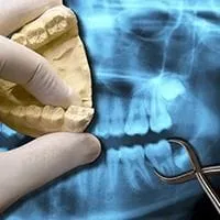TOOTH EXTRACTIONS
