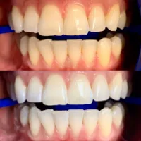 Teeth Whitening - Cosmetic Dentistry North Haven, CT