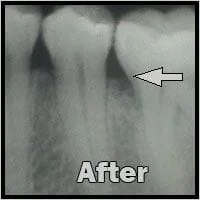 After regenerative bone graft_F Neal Pylant Athens GA_Periodontics_Dental Implants