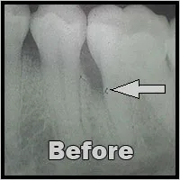 Before regenerative bone graft_F Neal Pylant Athens GA_Periodontics_Dental Implants