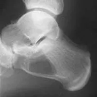 Bone Cysts / Tumors