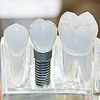 Dental Implants in Chandler, AZ