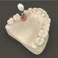 Dental Implants in Laramie, WY