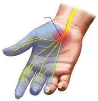 CUPERTINO Chiropractor | CUPERTINO chiropractic Carpal Tunnel Syndrome (CTS) | CA |