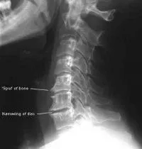 neck_xray2.jpg