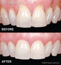 before and after teeth with root exposure due to gum disease, then after gum surgery North York, ON