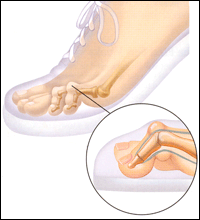 Hammer toe: MedlinePlus Medical Encyclopedia Image