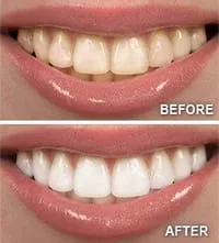 before and after images of yellowed teeth then after teeth whitening North York, ON