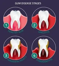 stages of gum infection Periodontitis Frederick, MD