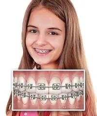 young girl smiling wearing metal braces North York, ON