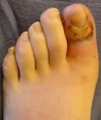 gangrene of the toe