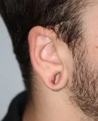 saggy earlobe