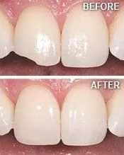 before and after image of chipped tooth being restored by dental bonding North York, ON dentist