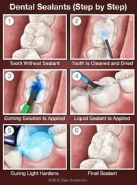 illustration showing steps cleaning teeth and applying sealants North York, ON