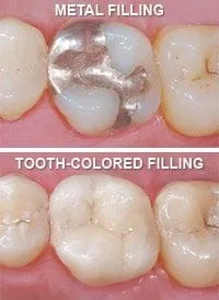 Metal fillings vs tooth-colored fillings Ann Arbor MI