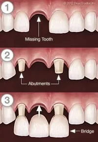 illustration of steps to replace missing tooth with dental bridge North York, ON dentist