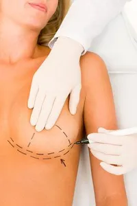 Breast Augmentation for Underdeveloped Breasts - Decatur, IL