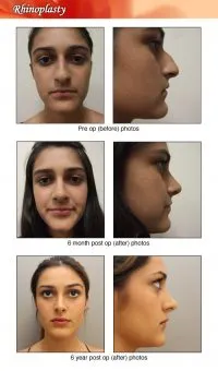 Before & After Of Rhinoplasty