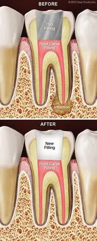 illustration of tooth with filling after root canal North York, ON