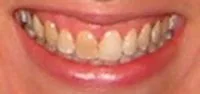 Before Cosmetic Tooth Bleaching