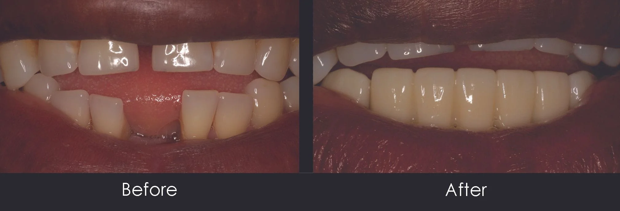 Before and After dental Bridge