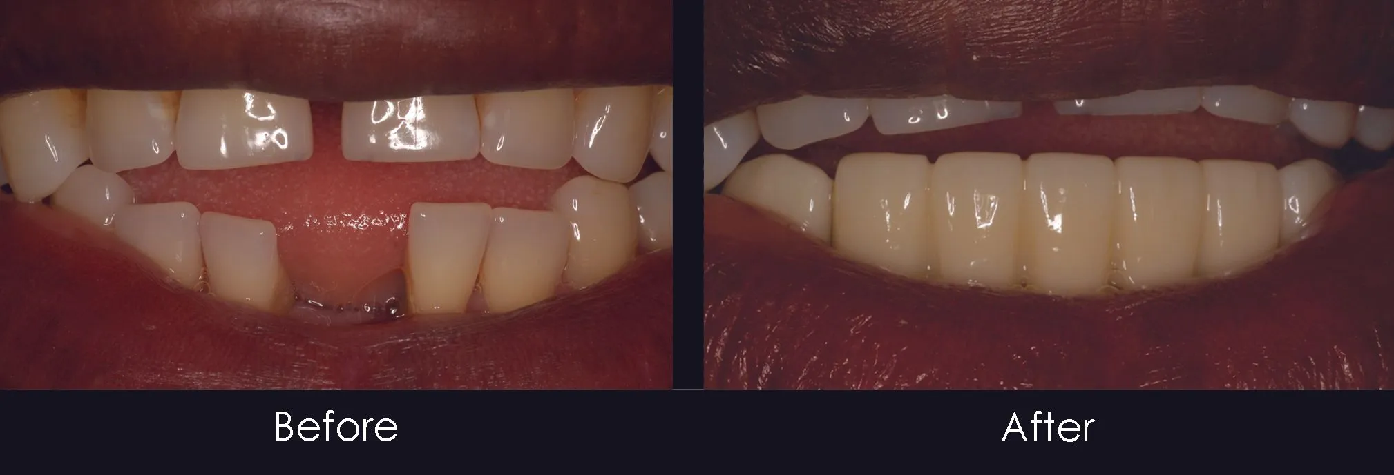 Before and After images of black man's mouth with missing tooth on bottom then after with dental bridge in place, Royal Palm Beach, FL dentist