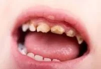 close up of child's brown damaged teeth from Baby bottle tooth decay, pediatric dentist Melrose, MA
