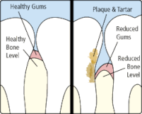 illustration of healthy teeth and gums versus teeth with plaque and tartar gum disease treatment Mill Creek, WA