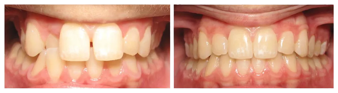 before and after results of teeth after Invisalign treatment Westminster, MD family dentist