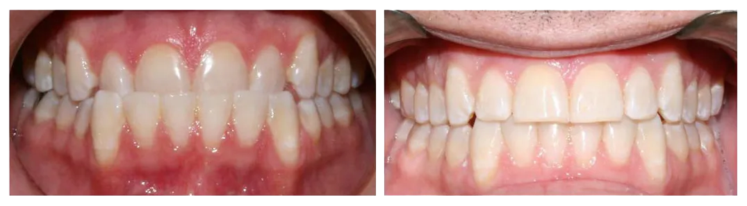 before and after images of mouth and teeth after using clear aligners Invisalign Westminster, MD dentist