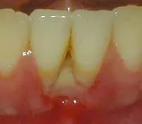 Pittsburgh periodontist picture of osteonecrosis of the jaw