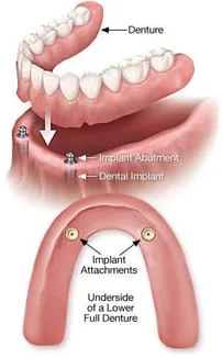 Denture supported by Dental Implants Bridgeport Fairfield CT