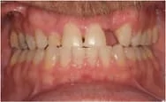 Pittsburgh periodontist picture before crown lengthening surgery