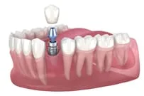 dental implant replace one tooth