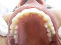 tooth_invisalign_2.jpg