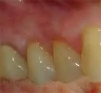 Pittsburgh periodontist picture of recession after surgery