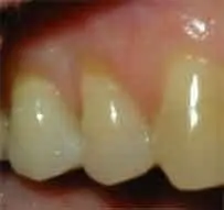 Pittsburgh periodontist picture of recession before surgery