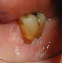Pittsburgh periodontist picture after crown lengthening to expose decay