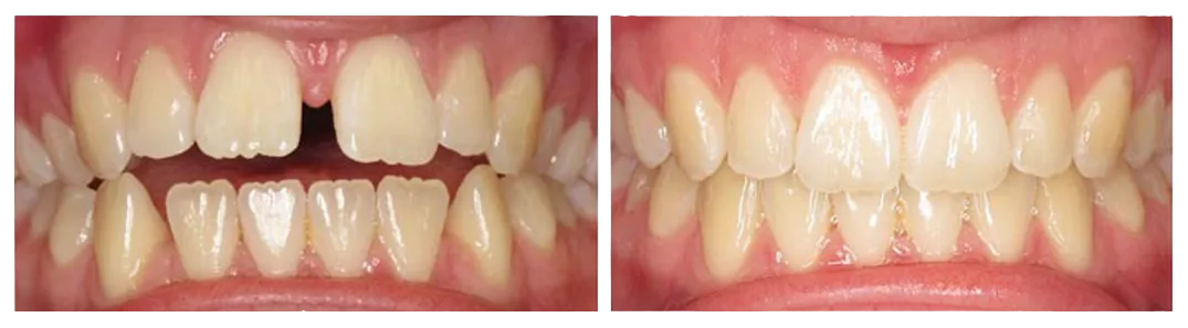 before and after image of gapped teeth corrected with clear aligner treatment, Invisalign Westminster, MD family dentist